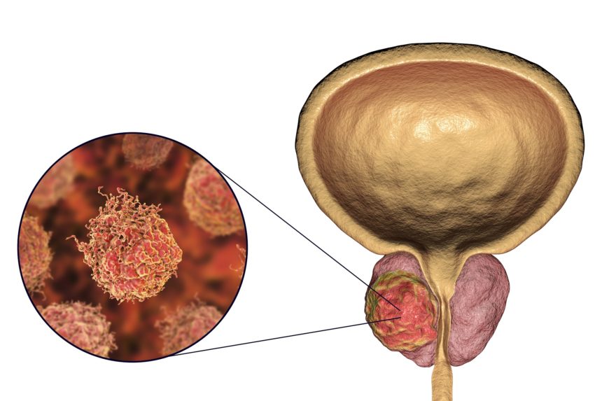 Tratamento para o câncer de próstata: quais são as fases?